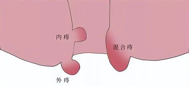 痔疮.png